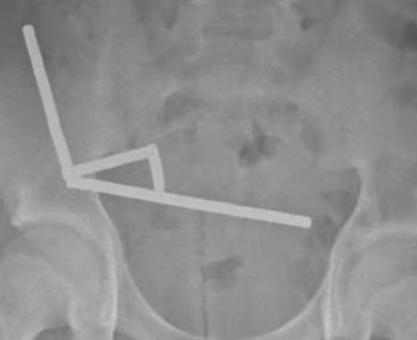 Menino engole mais de 80 ímãs, vai parar no hospital e perde parte do intestino